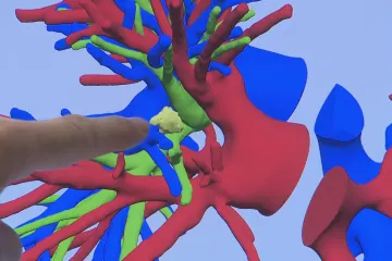 V pražském Motole odstranili nádor v plicích díky 3D modelu