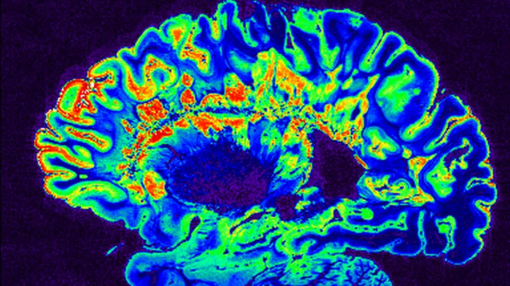 Mozek zobrazený pomocí technologie MRI
