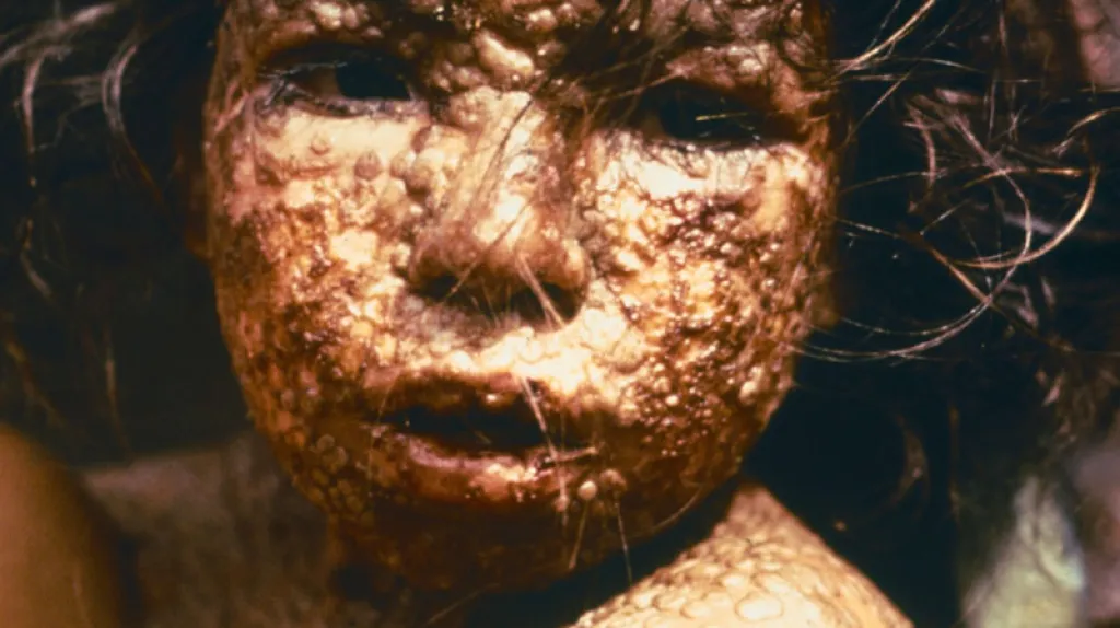 Dívka trpící neštovicemi