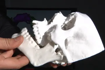 Italští lékaři využívají 3D modely poraněných orgánů. Pomáhají jim stanovit diagnózu i zkrátit čas operace