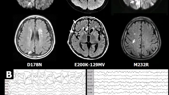 Obraz magnetické rezonance a záznam EEG člověka postiženého Creutzfeldt-Jakobovou nemocí