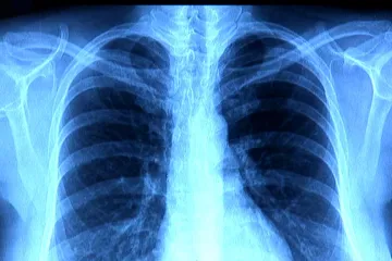 Postcovidovým syndromem trpí až polovina pacientů, většina ale jeho lehčí formou