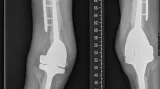 Rentgenový snímek Levona Hakobyana po sérii operací. Vidět jsou čtyři umělé klouby i výztuže kostí