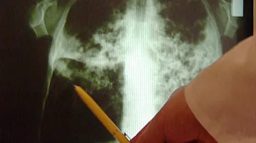 Rentgenový snímek člověka s tuberkulózou
