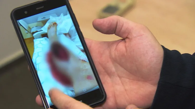 Daniel Beránek musel ležet 14 dní v nemocnici s otevřenou nohou