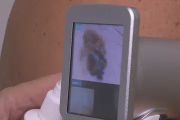 Melanom je jedním z nejčastějších zhoubných onemocnění v Česku, Lence ho objevili už v osmnácti