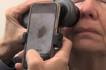 Stan proti melanomu nabízí vyšetření znamének zdarma. V Praze čekaly stovky lidí