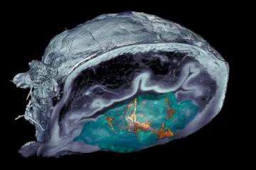 Španělští vědci zničili rakovinu močového měchýře pomocí nanorobotů. Stačil jediný zásah