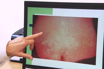 Spalničky se vrátily do Česka. První případy jsou mezi neočkovanými