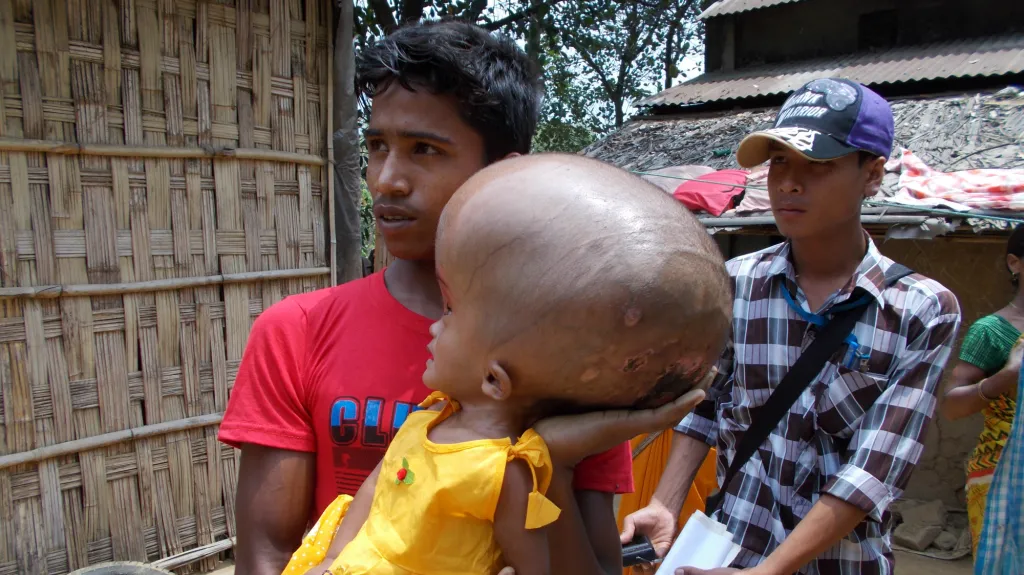Indická dívka trpící hydrocefalem