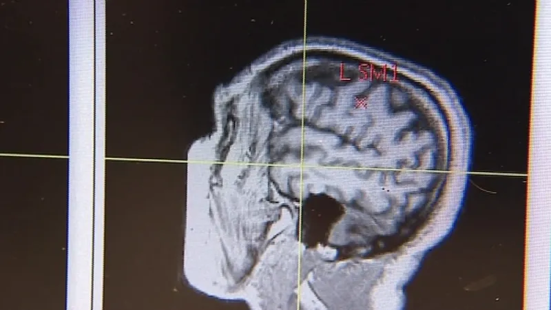 Parkinsonova nemoc se projevuje odumíráním nervových buněk