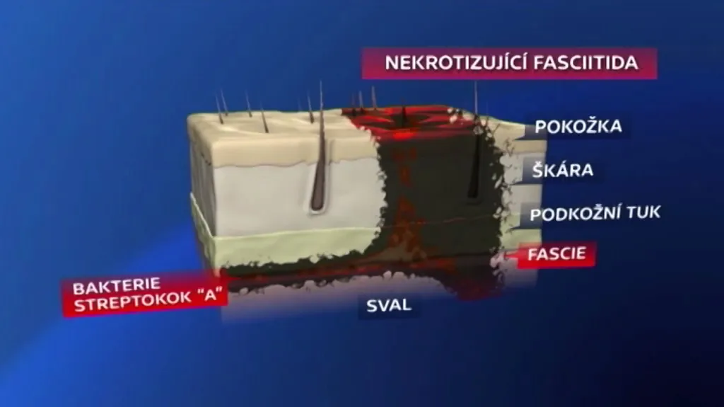 Nekrotizující fasciitida