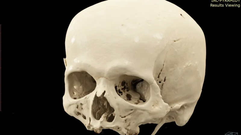 3D sken Mendelovy lebky