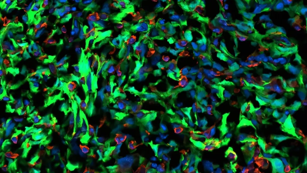 Rakovinné buňky (označené zeleně) komunikují s astrocyty (označenými červeně) v mozku, aby využily stavební bloky vylučované astrocyty. Buněčná jádra jsou označena modře