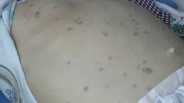 Akutní leukémie dětského pacienta