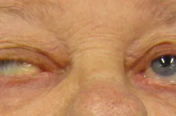 Myasthenia se tváří jako únava, může být ale velmi nebezpečná