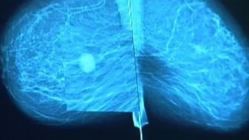 Patologické ložisko