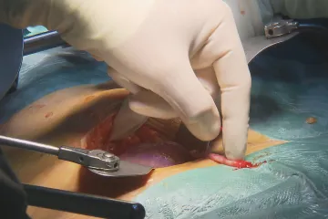 Na Vídeňské i ve Vídni. Souběžné operace zahájily mezinárodní řetězovou transplantaci ledvin