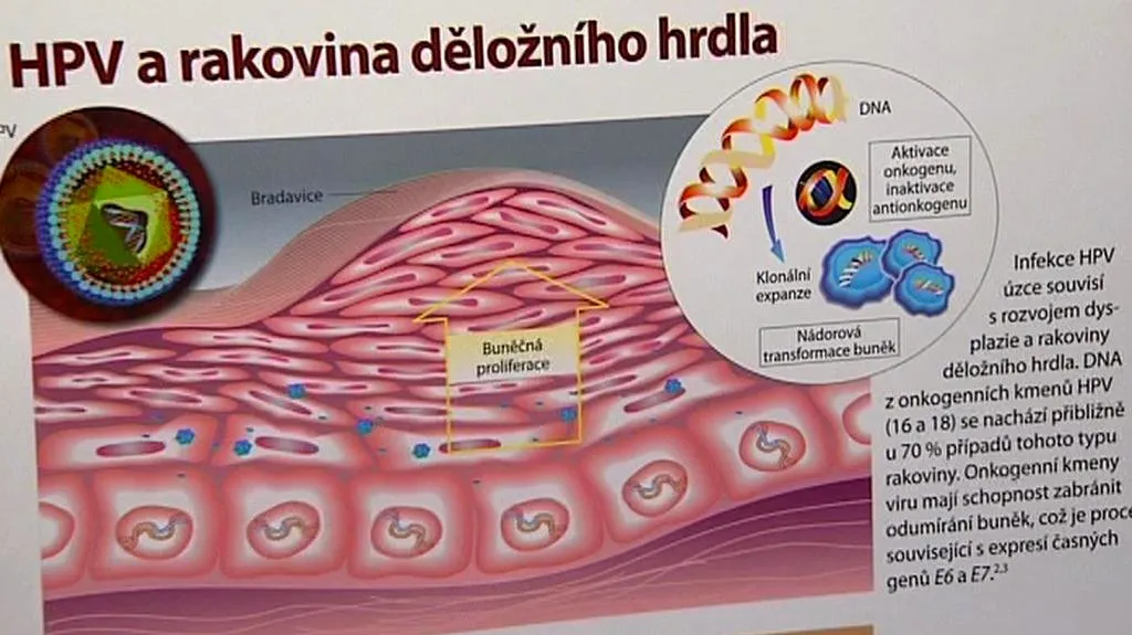 Rakovina děložního čípku