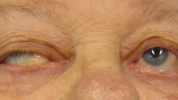 Typický příznak mygry je neschopnost udržet otevřené oči