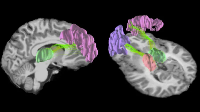 Oblasti mozku nejvíc poškozené nárazy