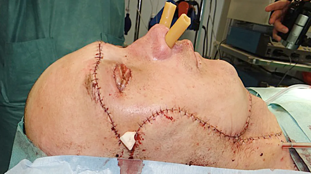 Muž, kterému v Polsku transplantovali obličej