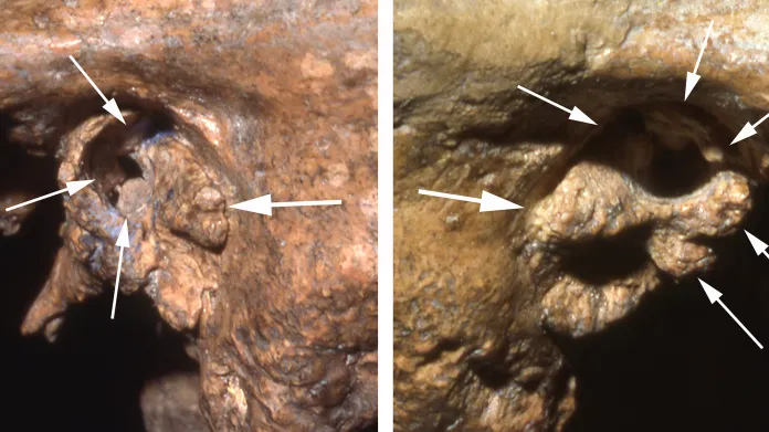 Poškozené zvukovody neandertálce