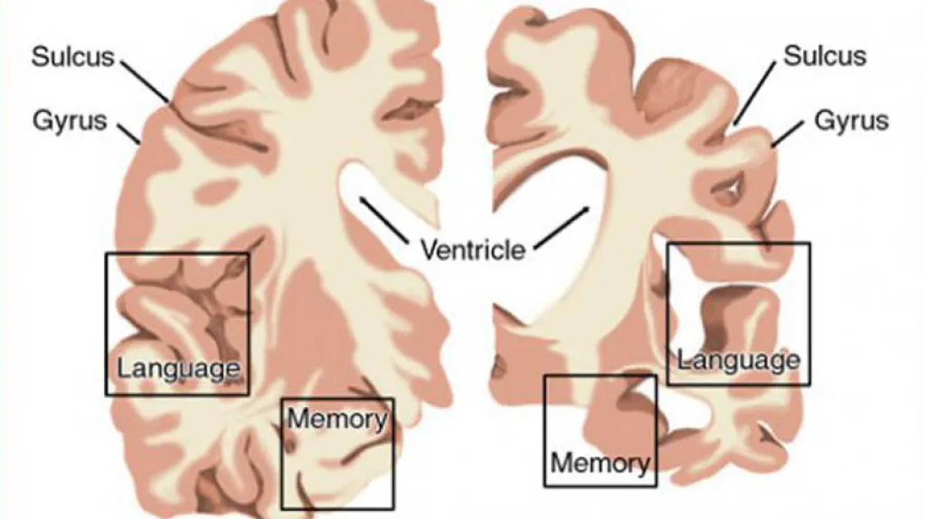 Zdravá část mozku proti nemocnému mozku