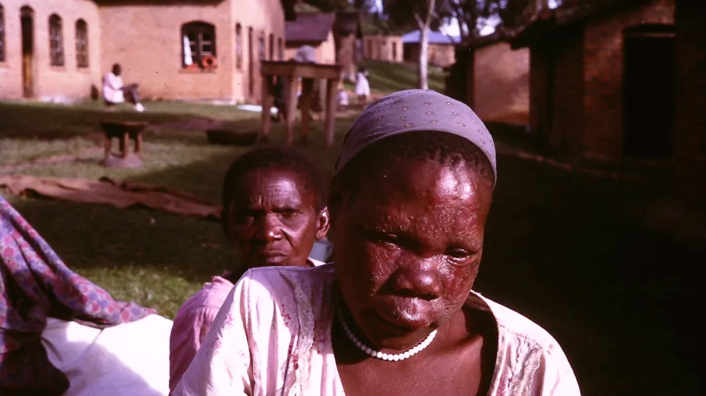 Leprosárium v Ugandě