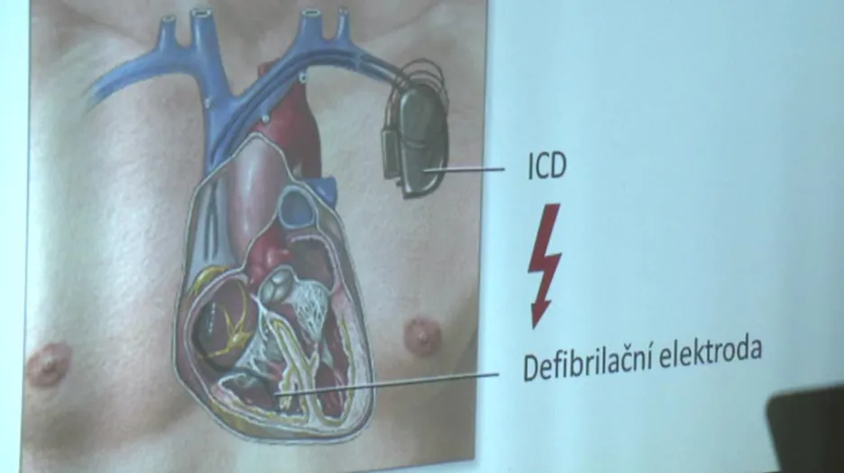 ICD přístroj