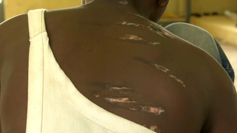Šrámy po mučení v nigerijské islámské škole