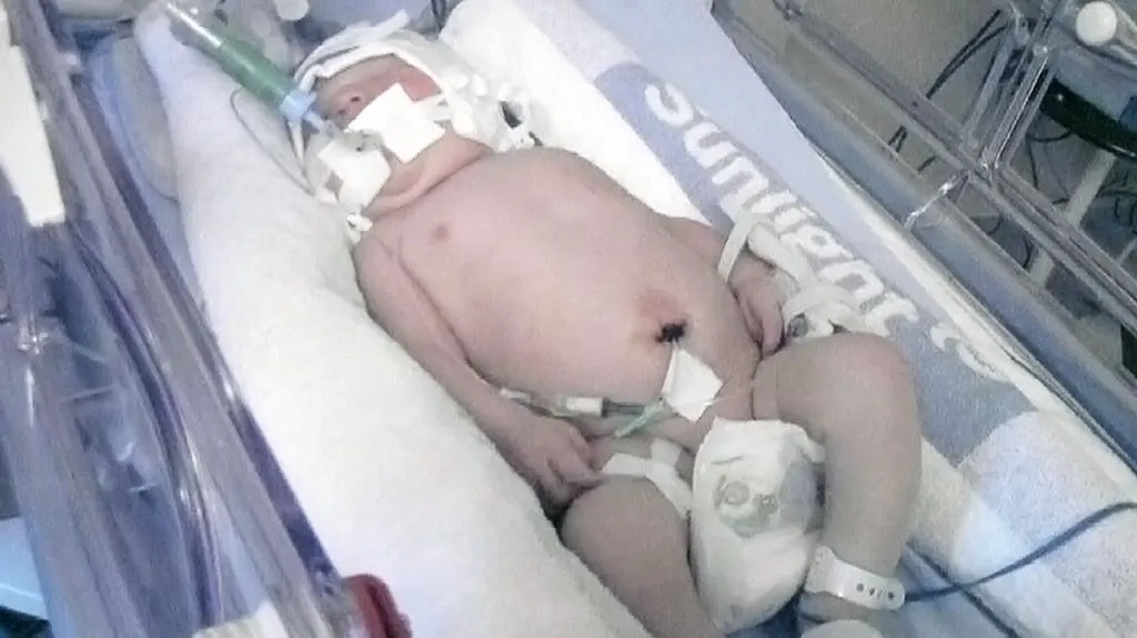 Novorozenec v přístroji Tecotherm Neo