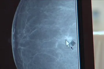 Studie: Umělá inteligence je v diagnóze rakoviny prsu úspěšnější než lidé