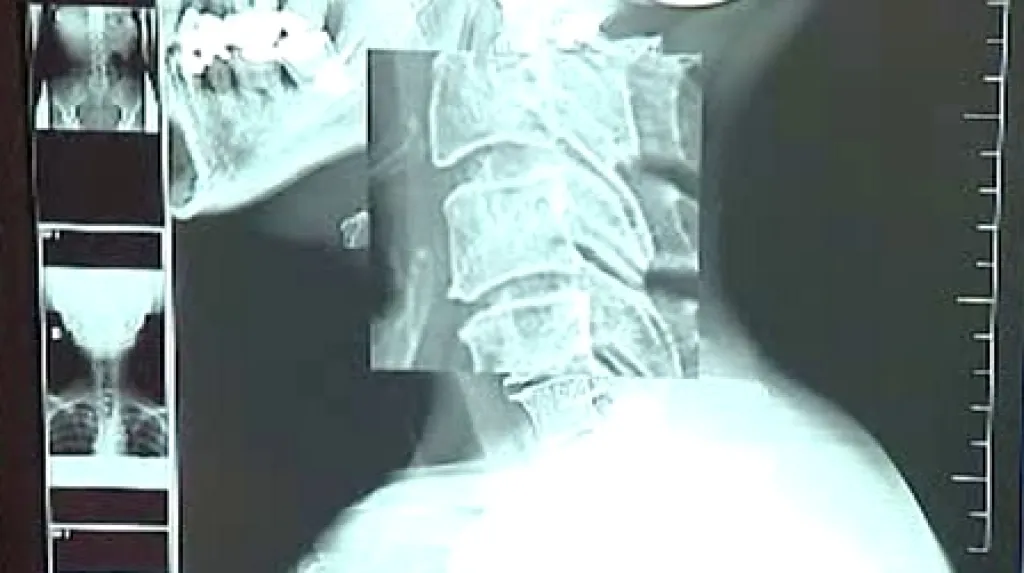 Rentgen s přímou digitalizací