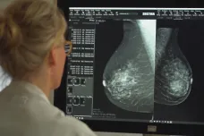 Rakovinu prsu ve Švédsku pomáhá odhalit umělá inteligence. Plnou důvěru ale nemá