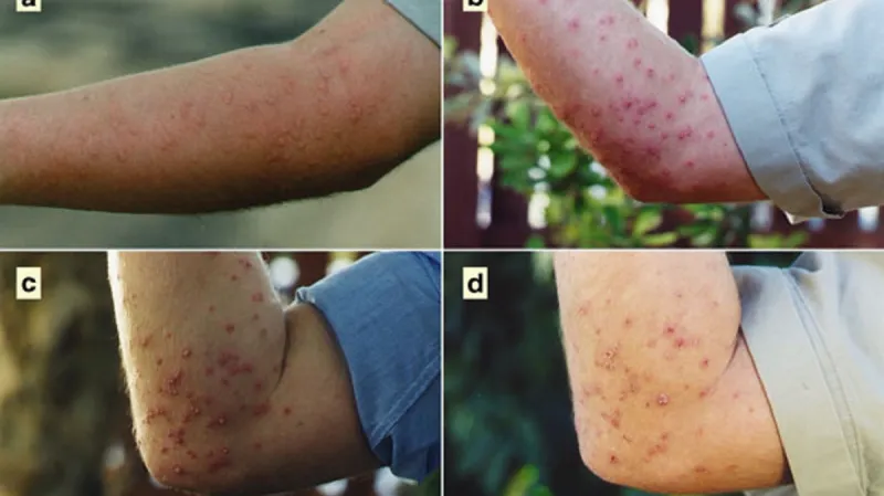 Důsledky pobodání mravencem Solenopsis invicta