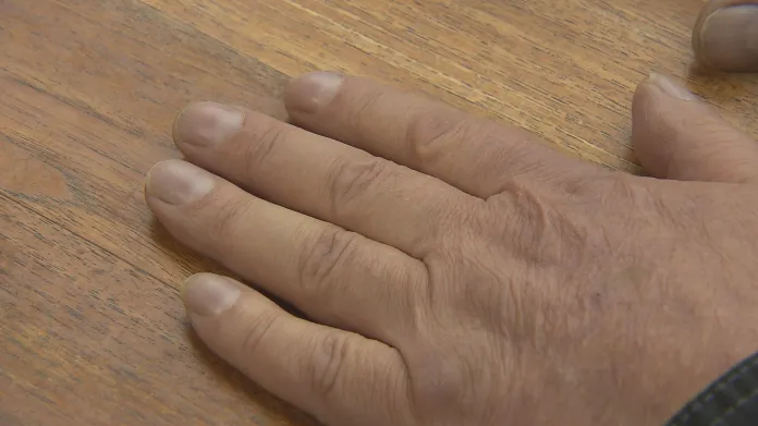 Prsty pacienta s plicní fibrózou