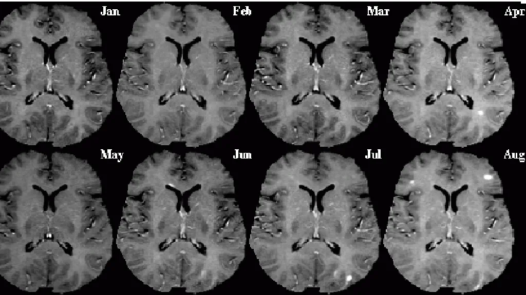 Roztroušená skleróza