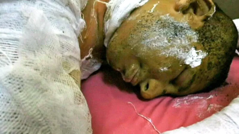 Oběť útoku zápalnou látkou na školu u Aleppa