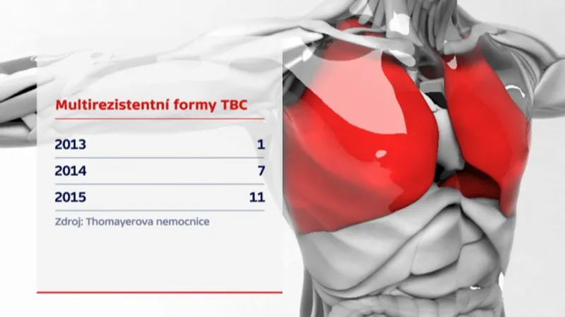 Události: Výskyt multirezistentní tuberkulózy se v posledních letech zvyšuje