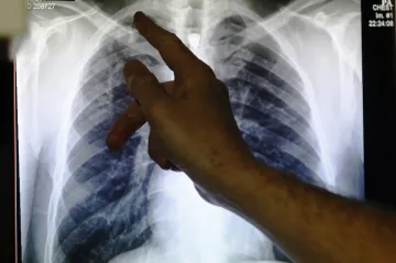 Tuberkulóza už ignoruje antibiotika. Léčba odolné varianty trvá až dva roky a často nebývá úspěšná