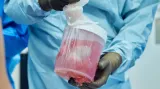Transplantace prasečích ledvin člověku