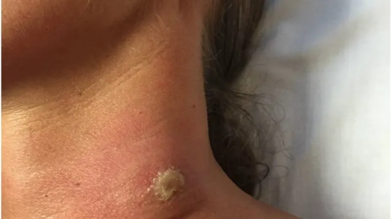 Vředy spojené se spavou nemocí