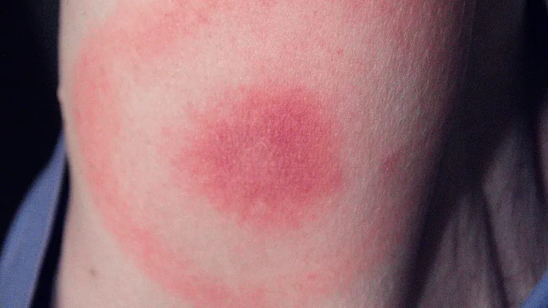 Erythema migrans nejčastěji připomíná terč. Je typickým příznakem Lymeské boreliózy