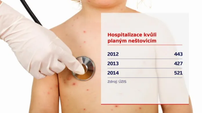 Hospitalizace kvůli planým neštovicím