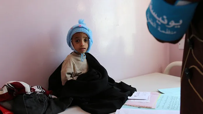 Podvyživené dítě v Jemenu