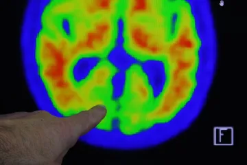 Spor o léky na Alzheimerovu nemoc. Studie tvrdí, že nejsou účinné, část vědců nesouhlasí