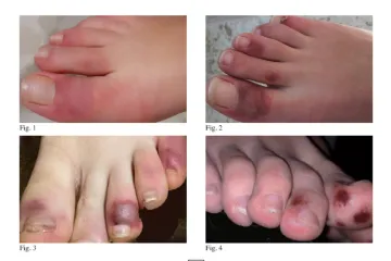 Příznakem nákazy koronavirem jsou i „covidové prsty“, upozorňují čeští a italští experti