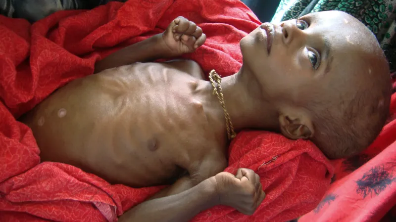 Hladomor v Somálsku