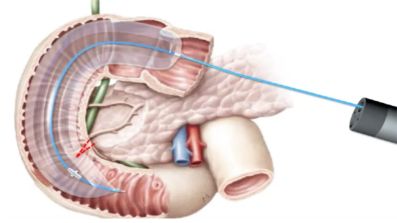 Léčba diabetu 2. typu laserem zasáhne dvanáctník